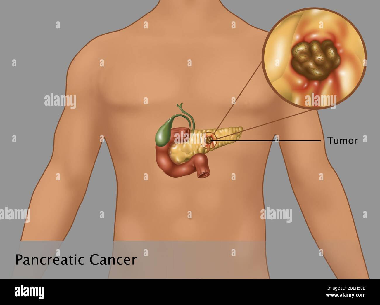 Illustration of pancreatic cancer inset in an outline of a male figure. At center of the pancreas is the tumor (brown area). Also present are the gallbladder (green) and duodenum (burnt red). Stock Photo