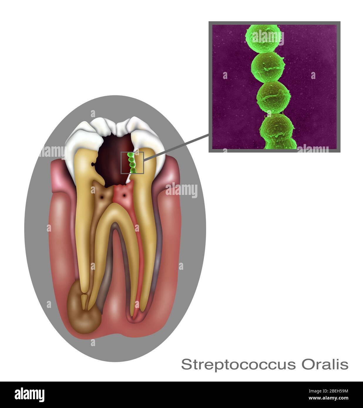 Oral Infection of Streptococcus Oralis Stock Photo