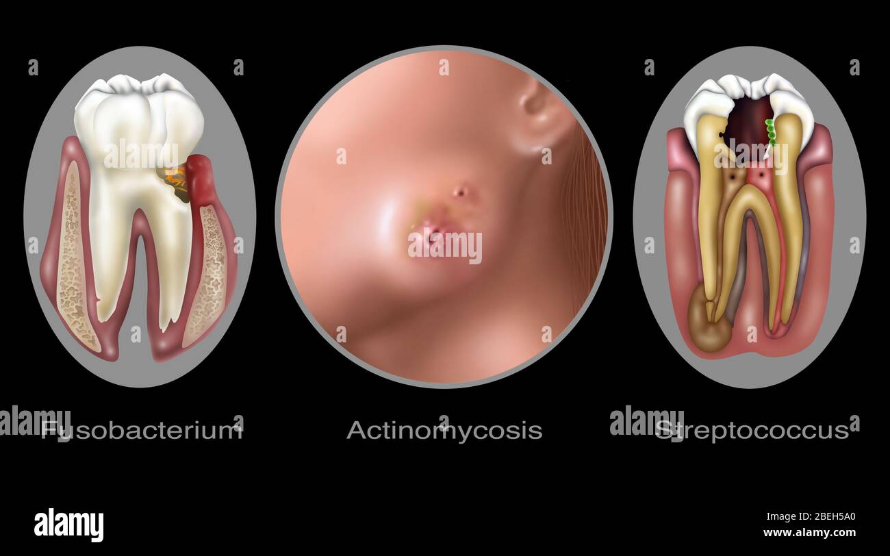 Oral Infections, Illustration Stock Photo