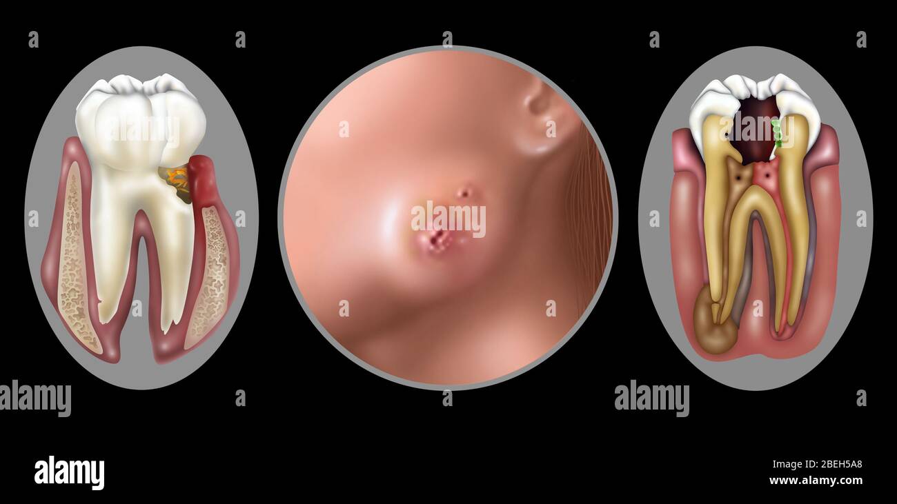 Oral Infections, Illustration Stock Photo