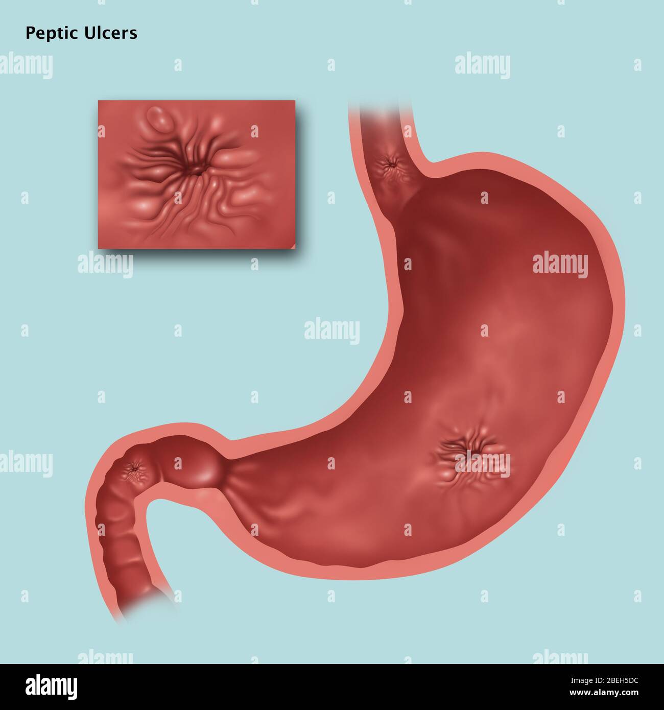 Stomach Ulcers, Illustration Stock Photo Alamy