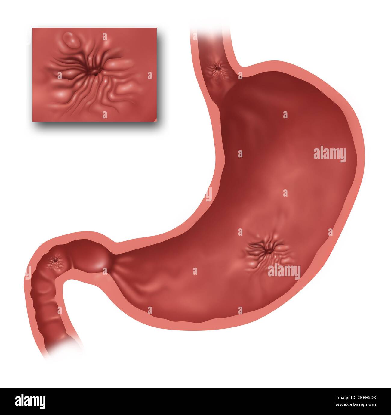 Illustration of the stomach with several ulcers present. At top is the esophagus and just below that is an esophageal ulcer. In the stomach a gastric ulcer is present, and at the bottom left is a duodenal ulcer in the small intestine. Inset is a close up of a peptic ulcer. Stock Photo