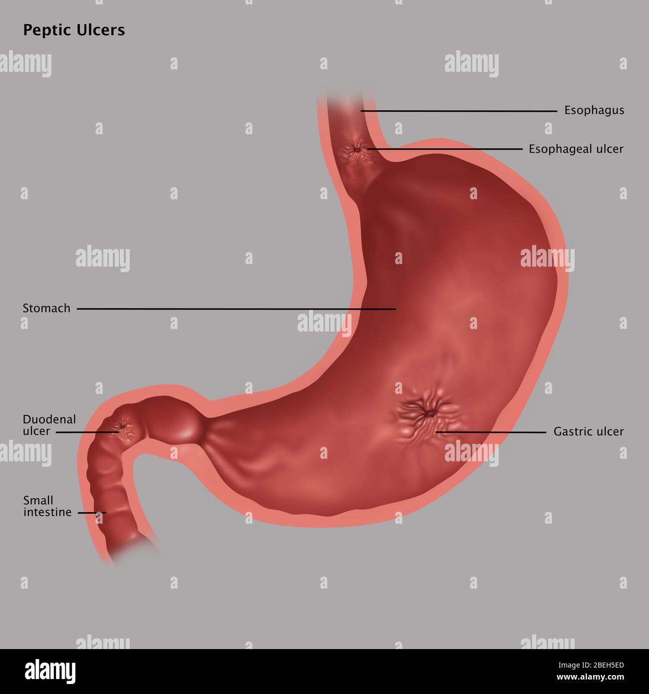 Stomach Ulcers, Illustration Stock Photo - Alamy