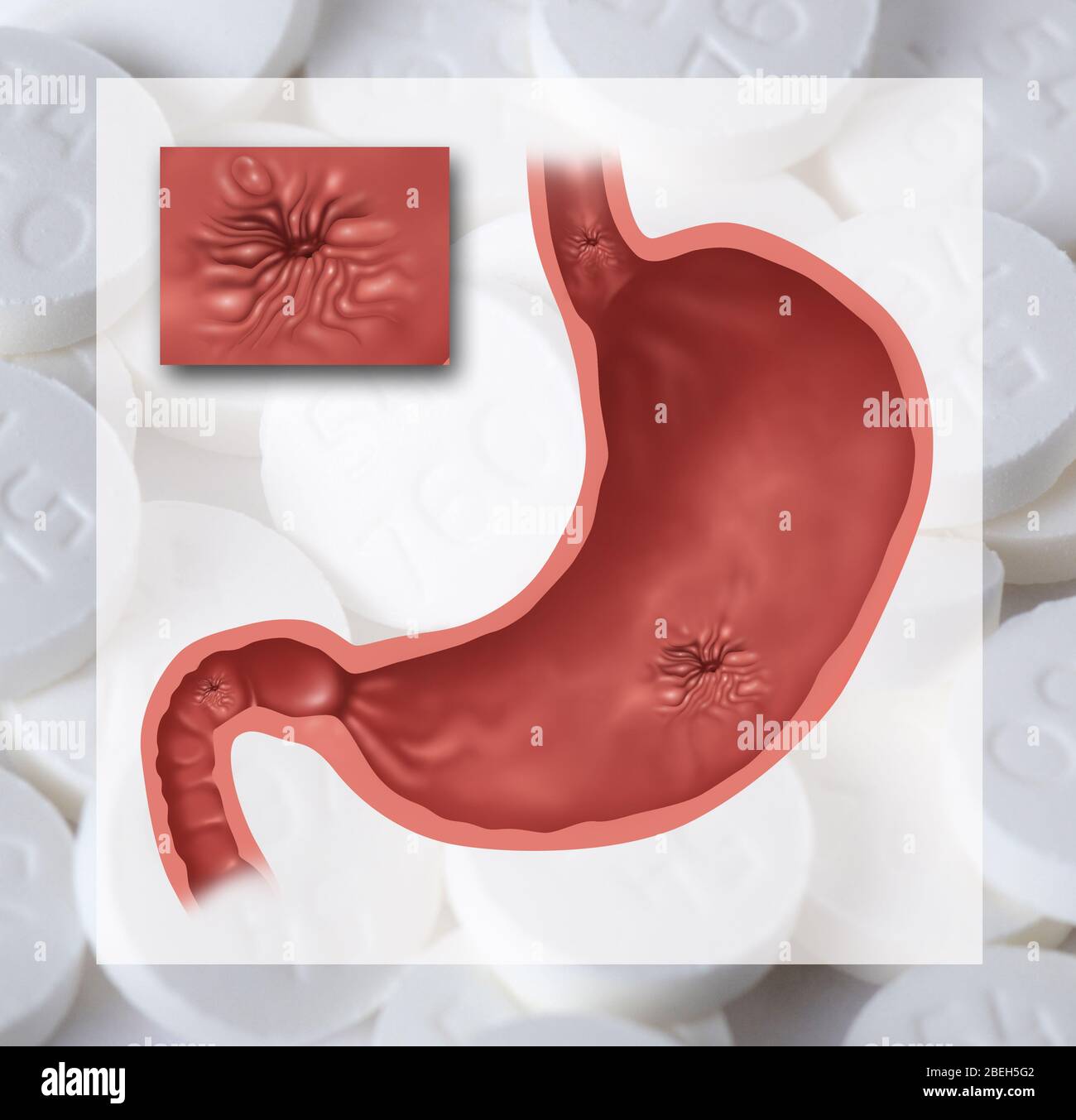 Stomach ulcer illustration hi res stock photography and images Alamy