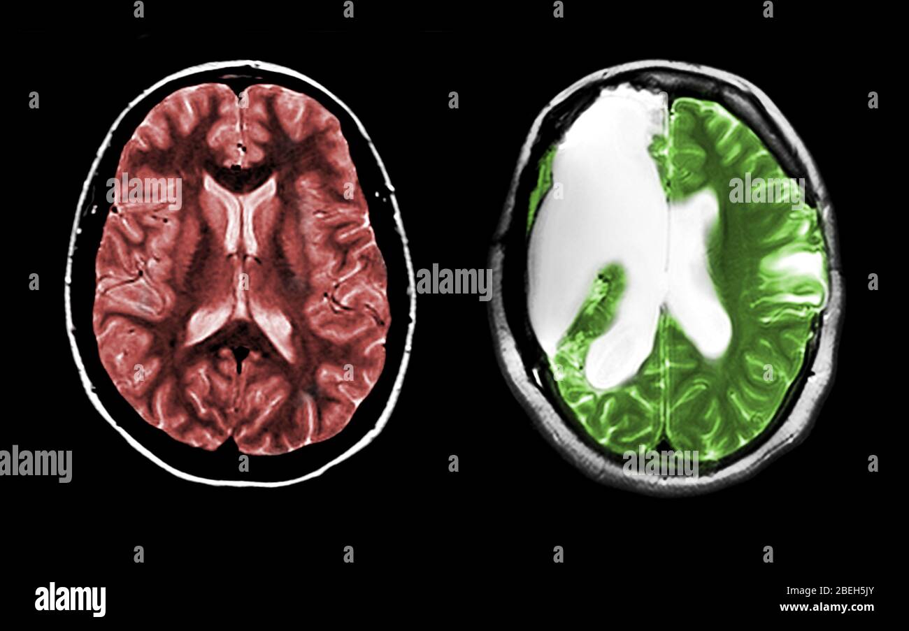 MRI of Normal Brain and Hemispherectomy Stock Photo