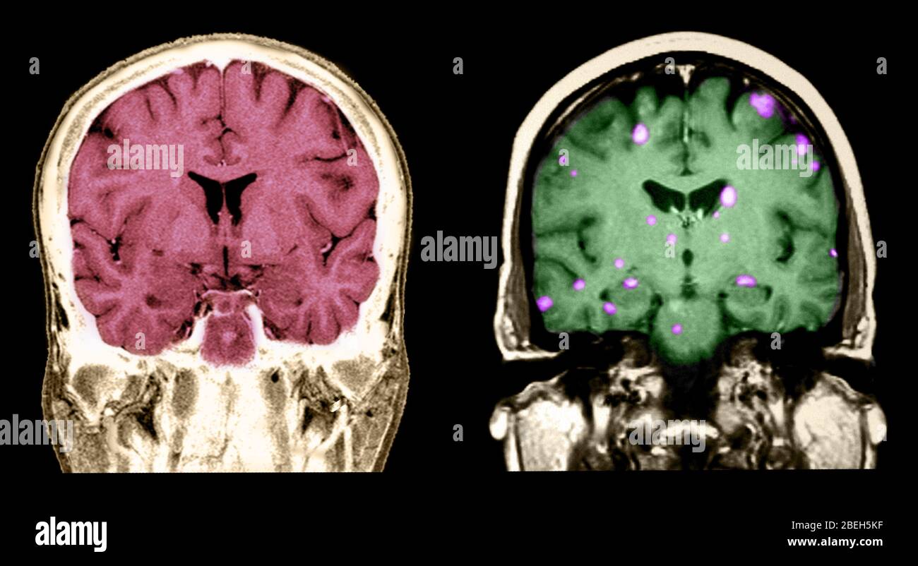 MRI of Normal Brain and Breast Cancer Metastasis Stock Photo