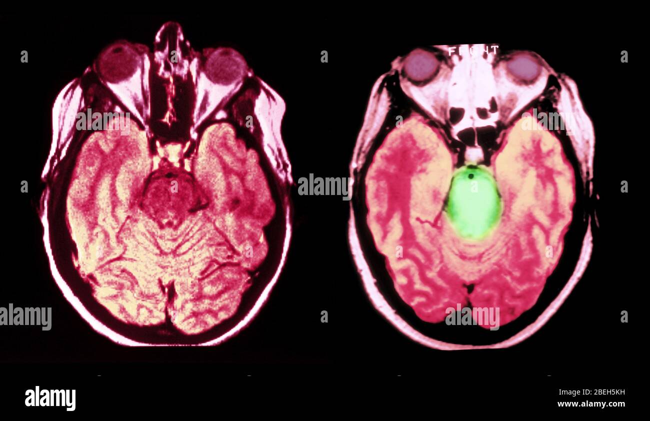 MRI of Normal Brain and Brainstem Glioma Stock Photo