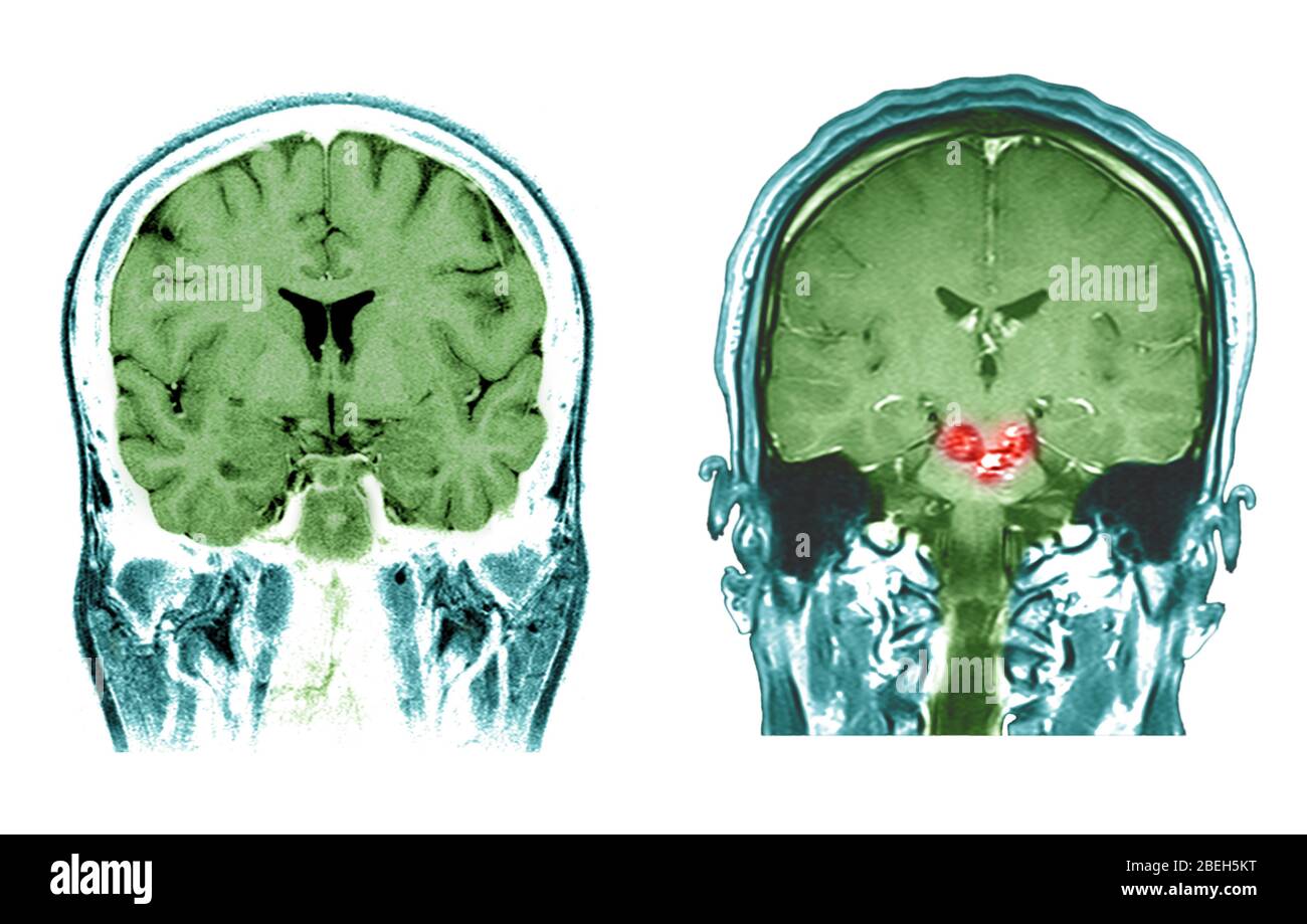 MRI of Normal Brain and Brainstem Malformations Stock Photo