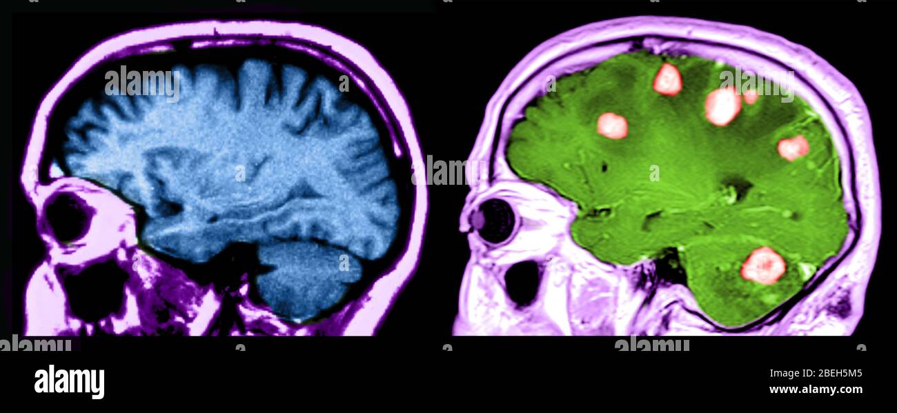 MRI of Brains, Normal and with Malignant Tumors Stock Photo
