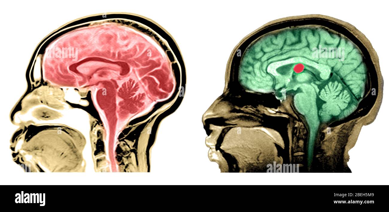 MRI of Normal Brain and Colloid Cyst Stock Photo