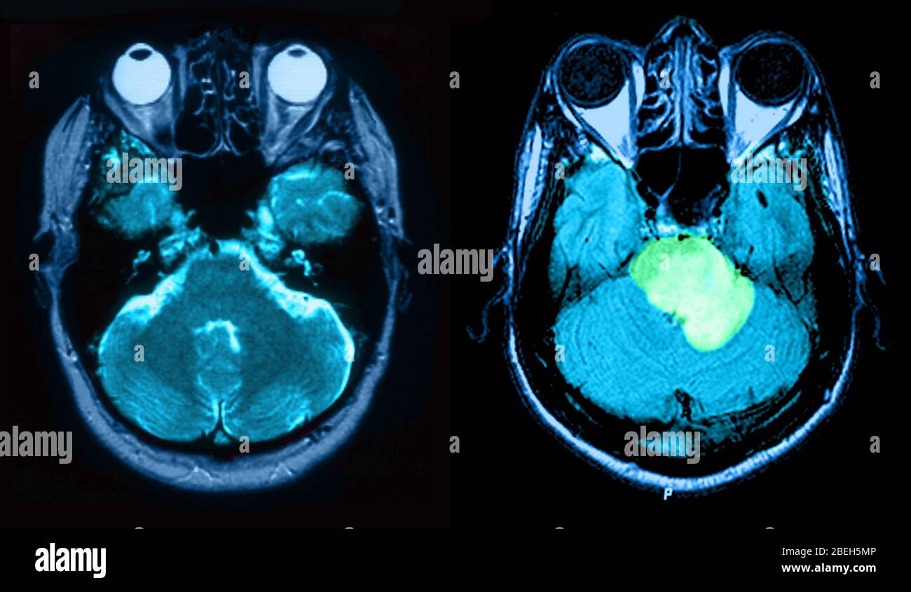 MRI of Normal Brain and Acute MS with Edema Stock Photo