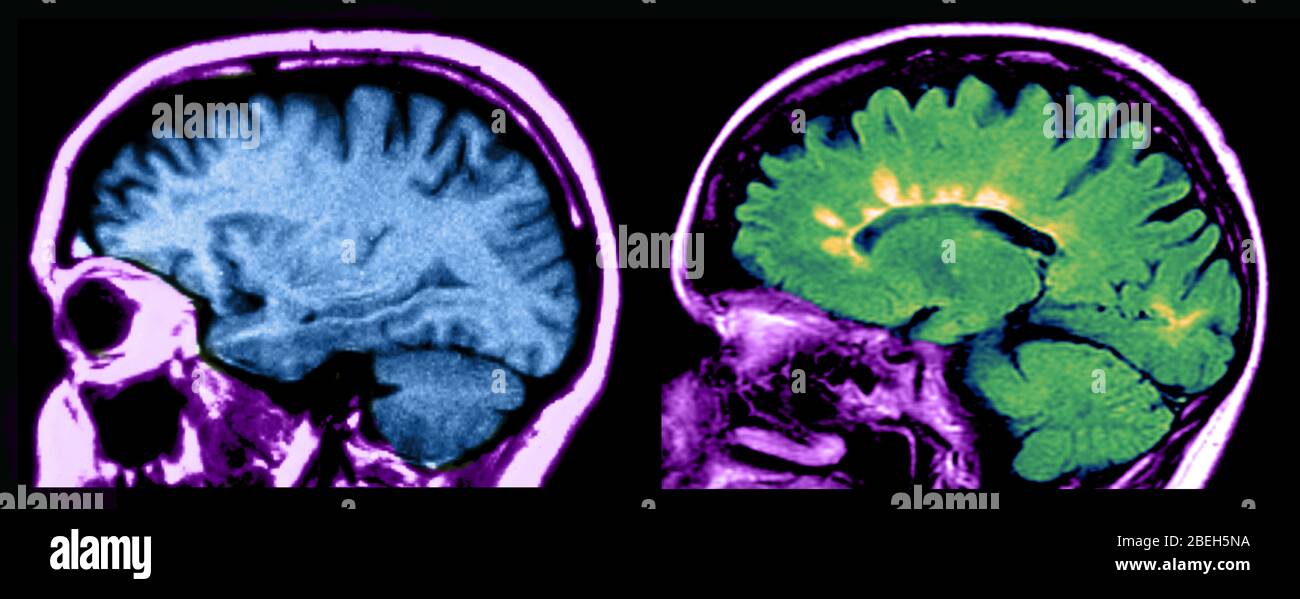MRI of Normal Brain and Multiple Sclerosis Lesions Stock Photo