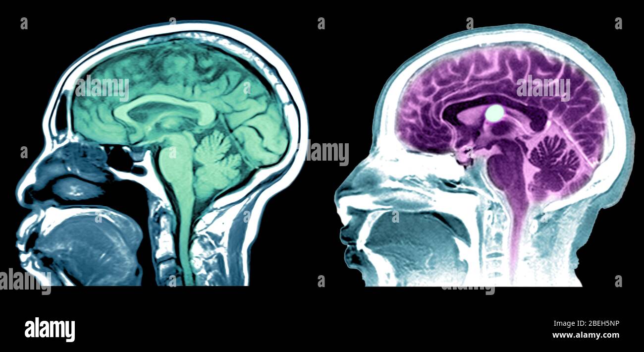 MRI of Normal Brain and Colloid Cyst Stock Photo