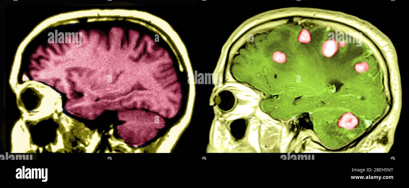 MRI of Brains, Normal and with Malignant Tumors Stock Photo