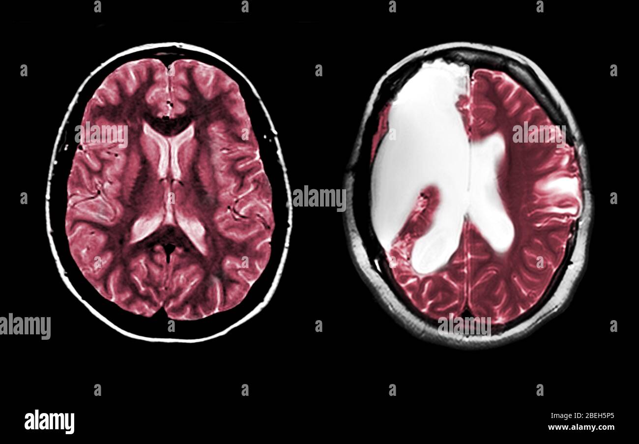 MRI of Normal Brain and Hemispherectomy Stock Photo