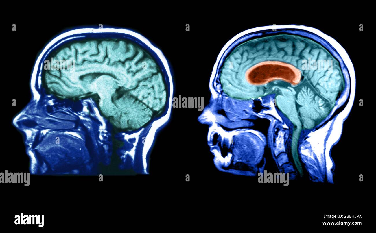 MRI of Normal Brain and Hydrocephalic Brain Stock Photo