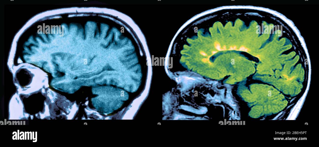 MRI of Normal Brain and Multiple Sclerosis Lesions Stock Photo