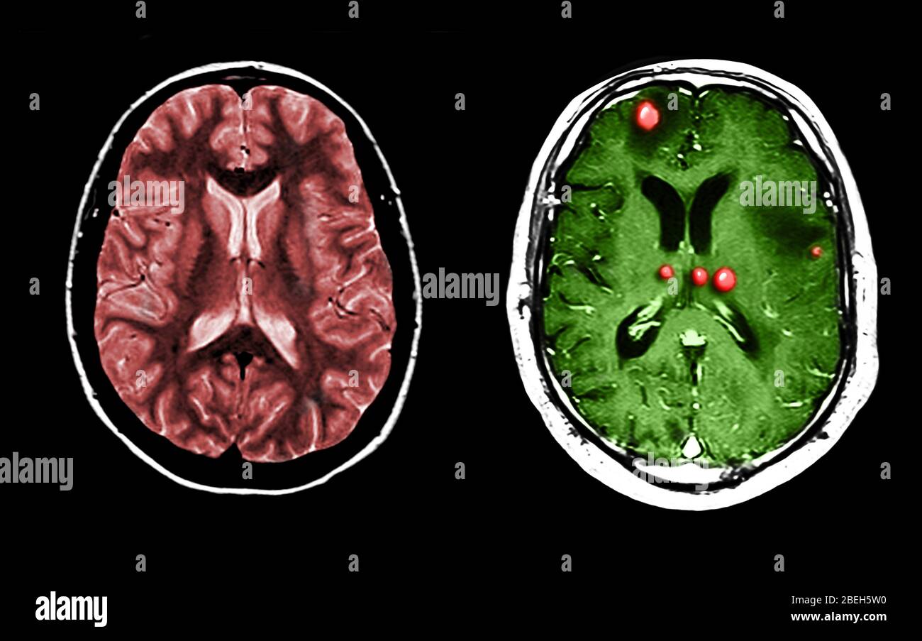 MRI of Normal and Tumor-Filled Brains Stock Photo