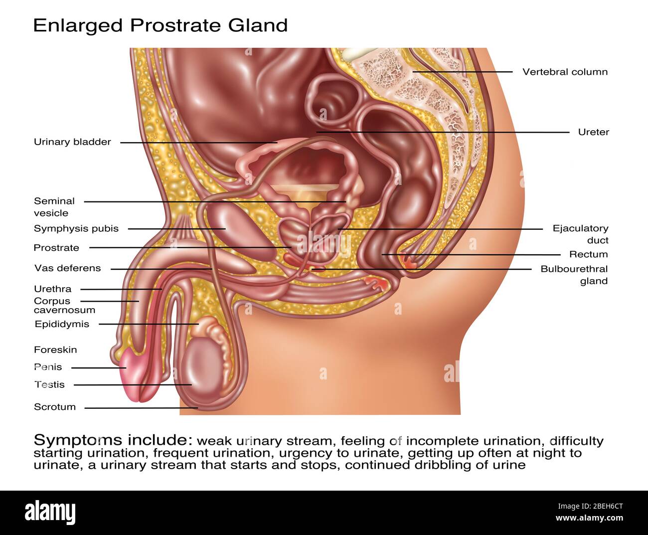Enlarged Prostrate Gland, Illustration Stock Photo - Alamy