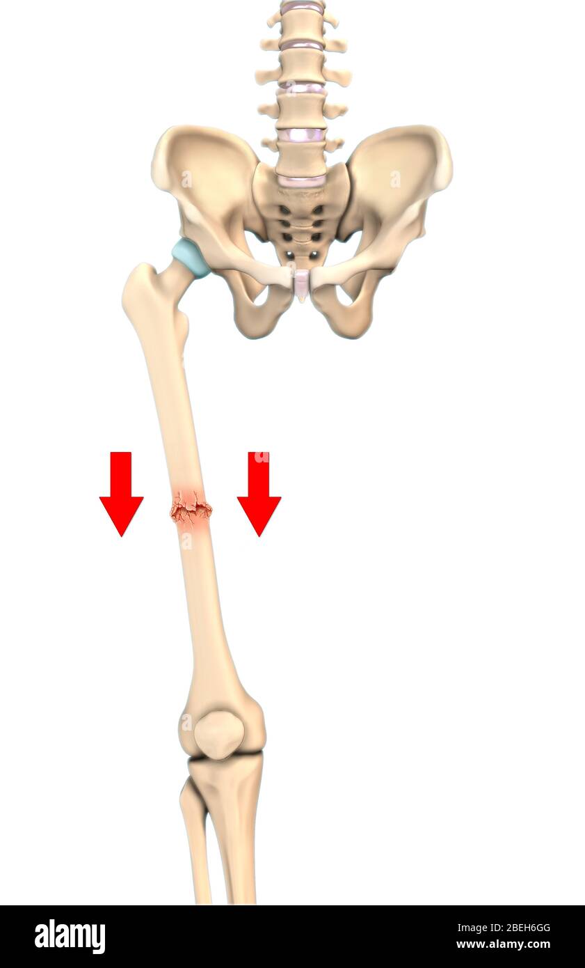 Impacted Bone Fracture, Illustration Stock Photo