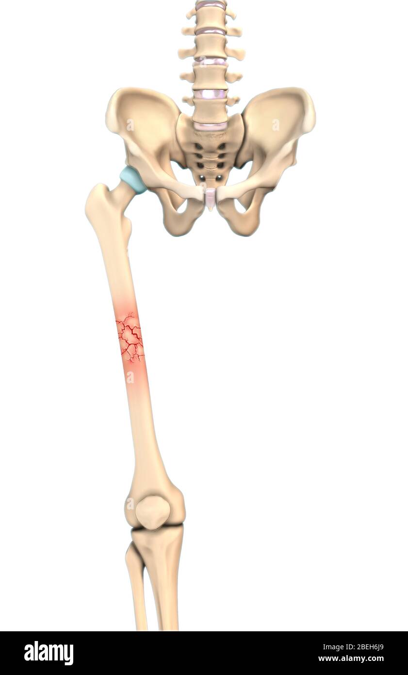 An illustration of a comminuted fracture in which the bone has broken into several pieces. Stock Photo