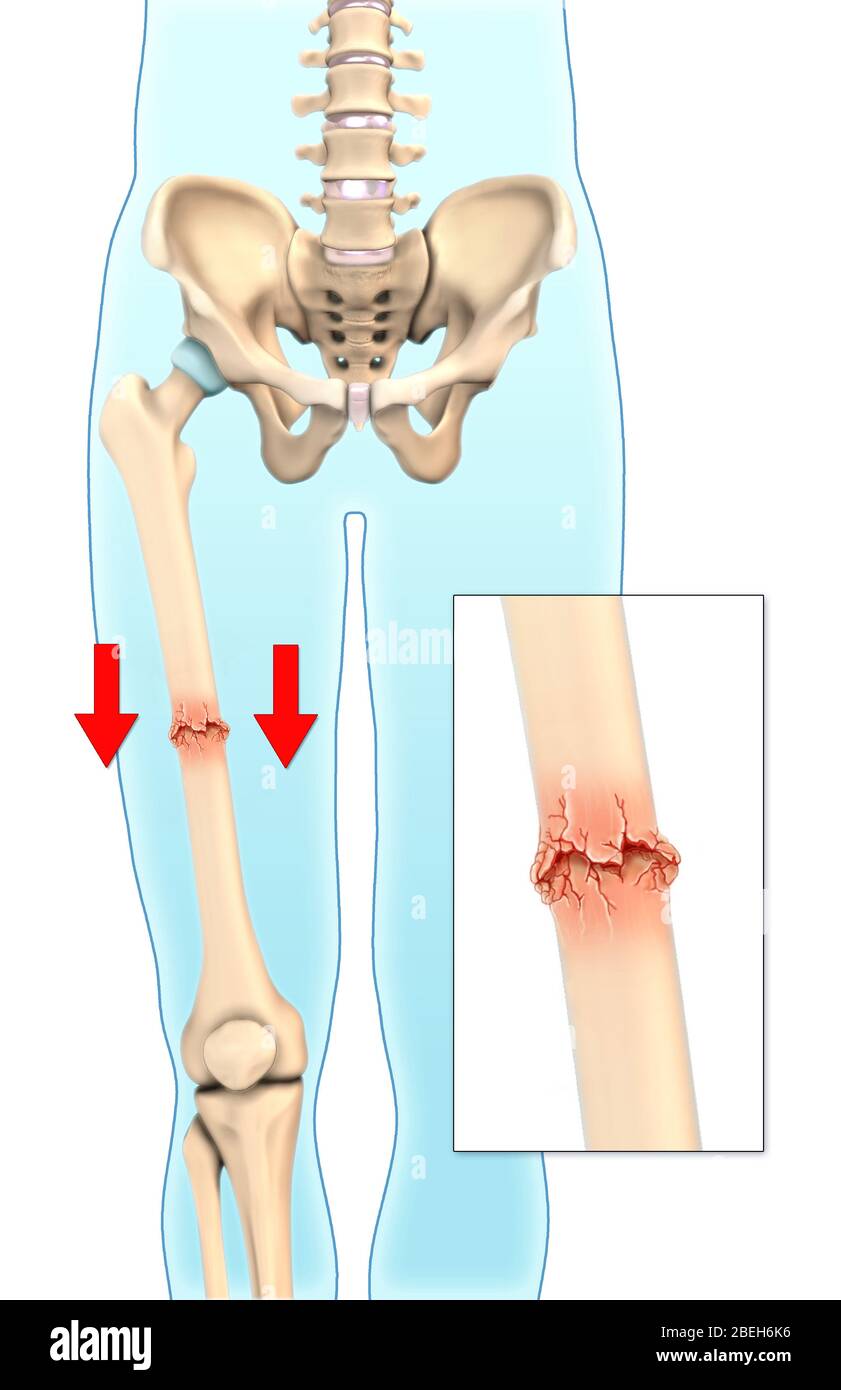 Impacted Bone Fracture, Illustration Stock Photo