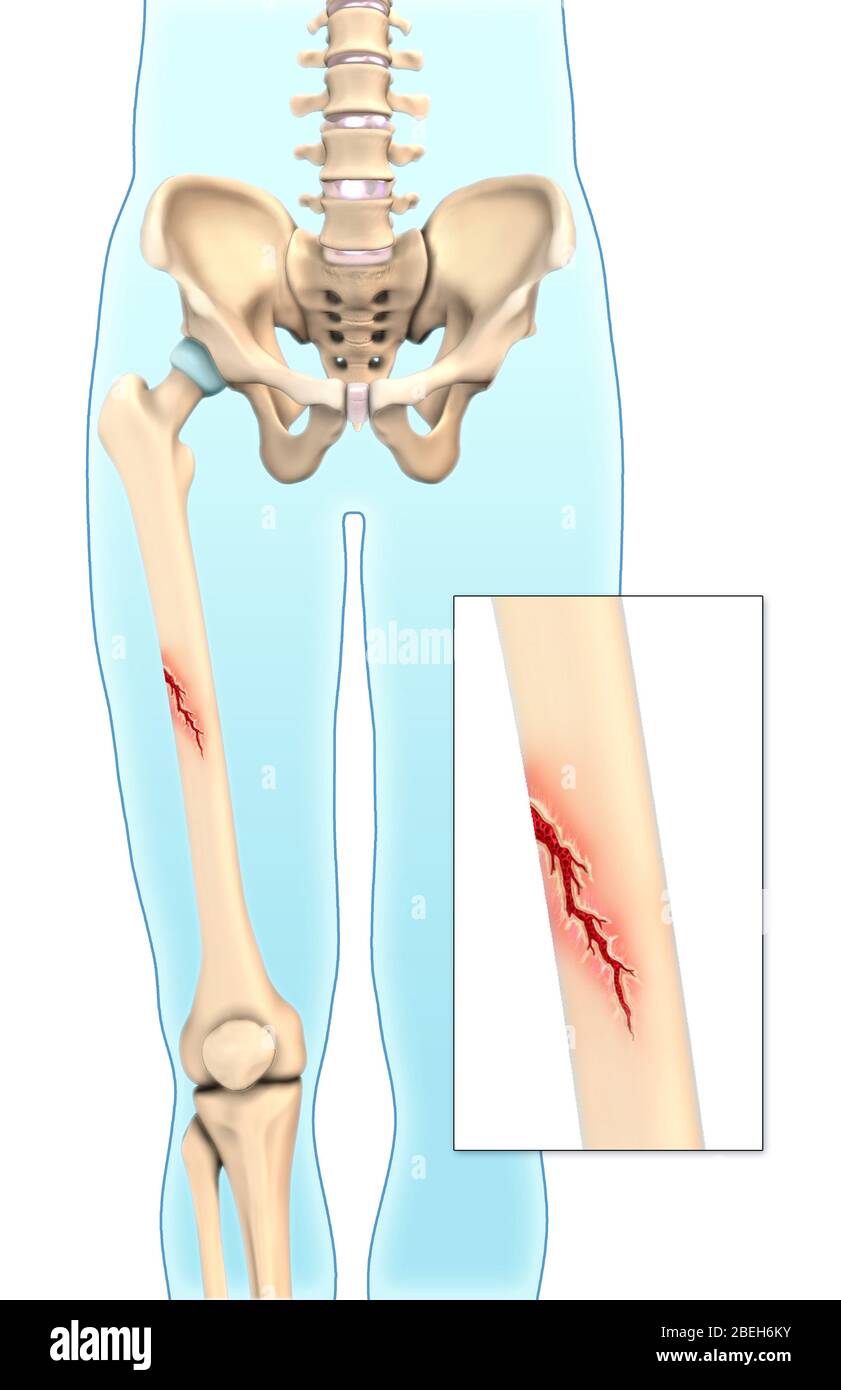 Greenstick Bone Fracture, Illustration Stock Photo