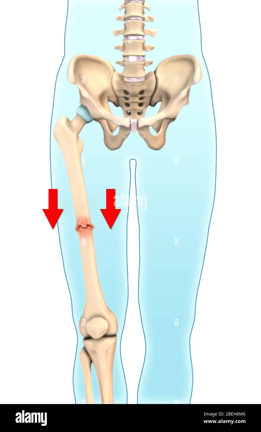 Impacted Bone Fracture, Illustration Stock Photo