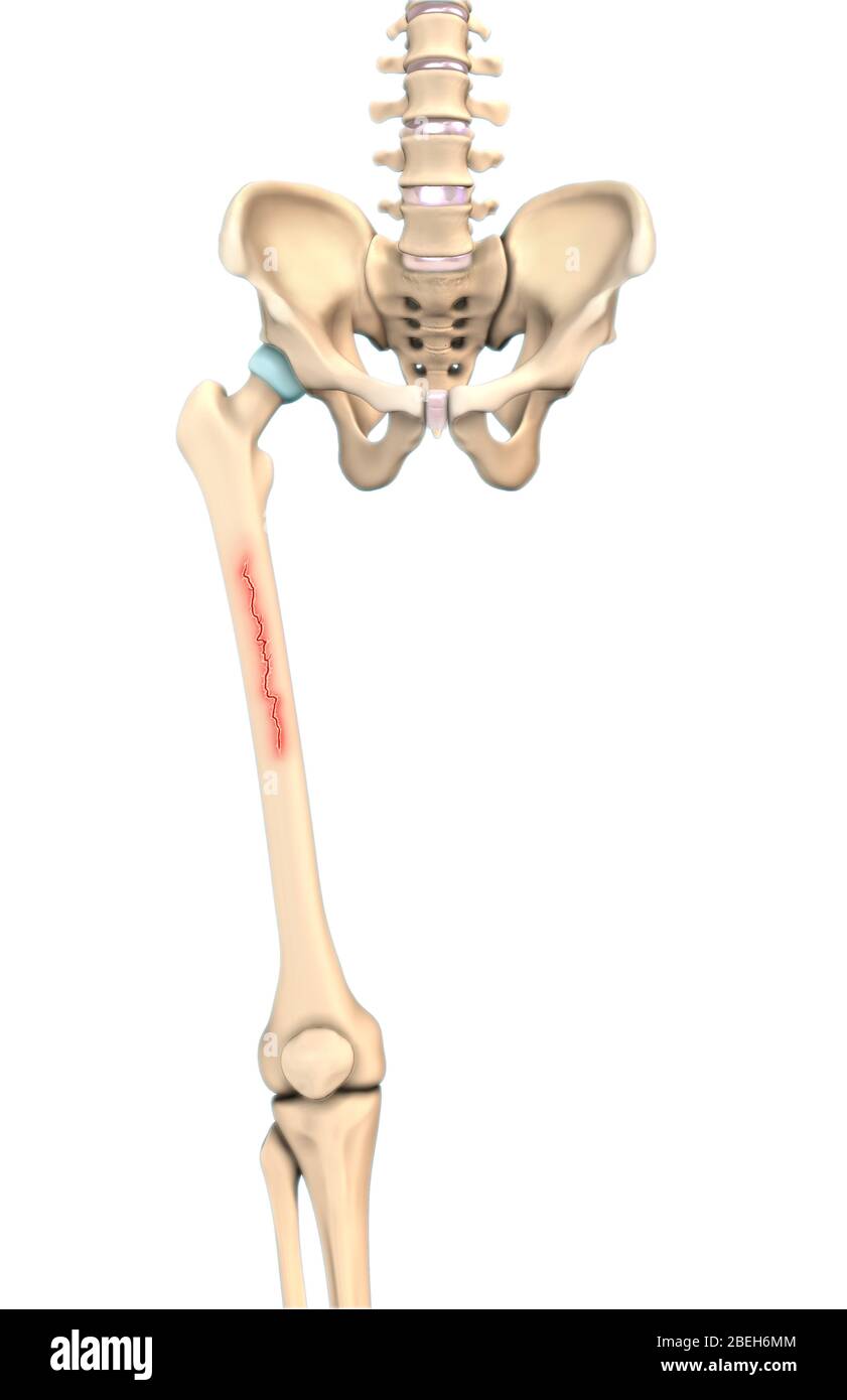 Linear Bone Fracture, Illustration Stock Photo