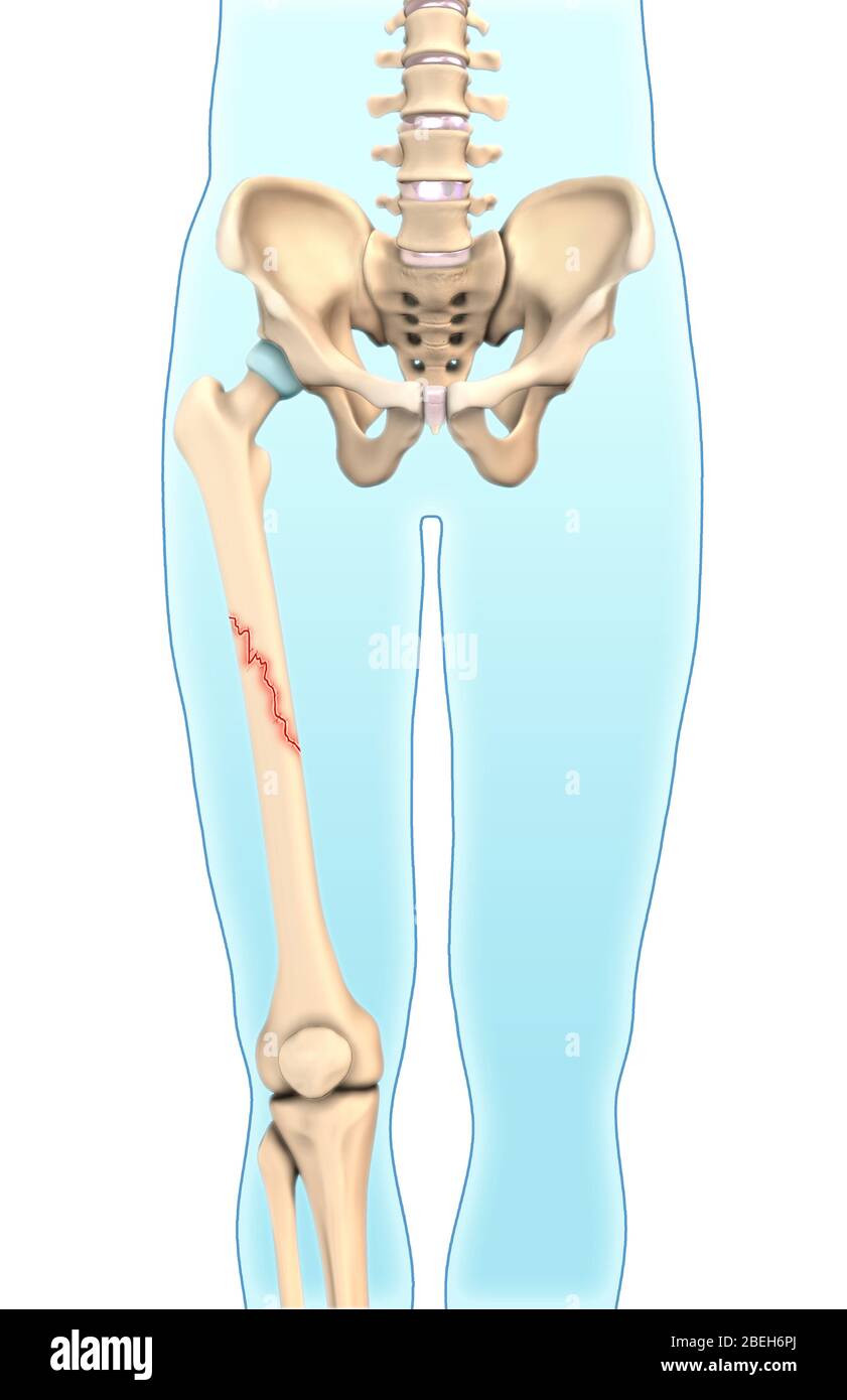 Oblique Bone Fracture, Illustration Stock Photo