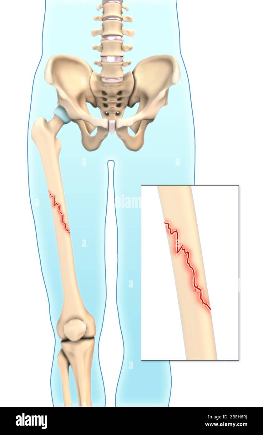 An illustration of an oblique fracture in which a break is diagonal to the bone's long axis. Stock Photo