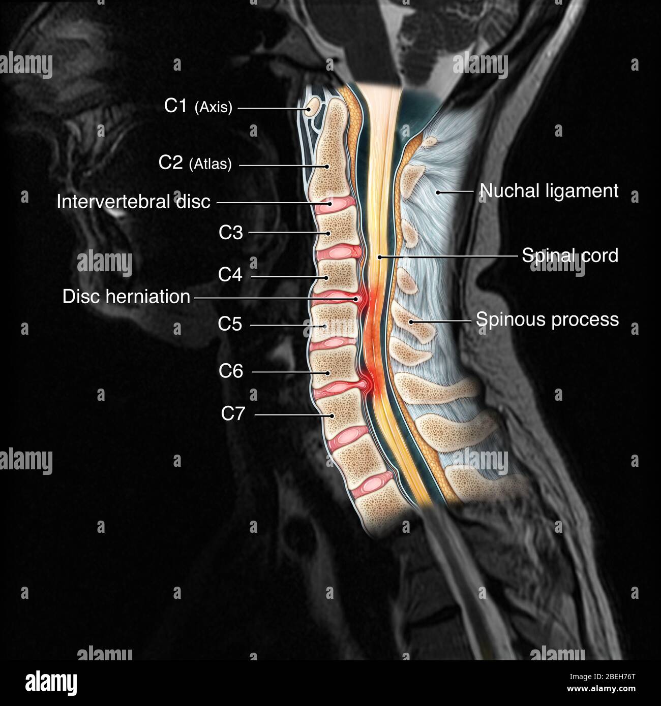 Cervical Spine Mri Labeled 9839
