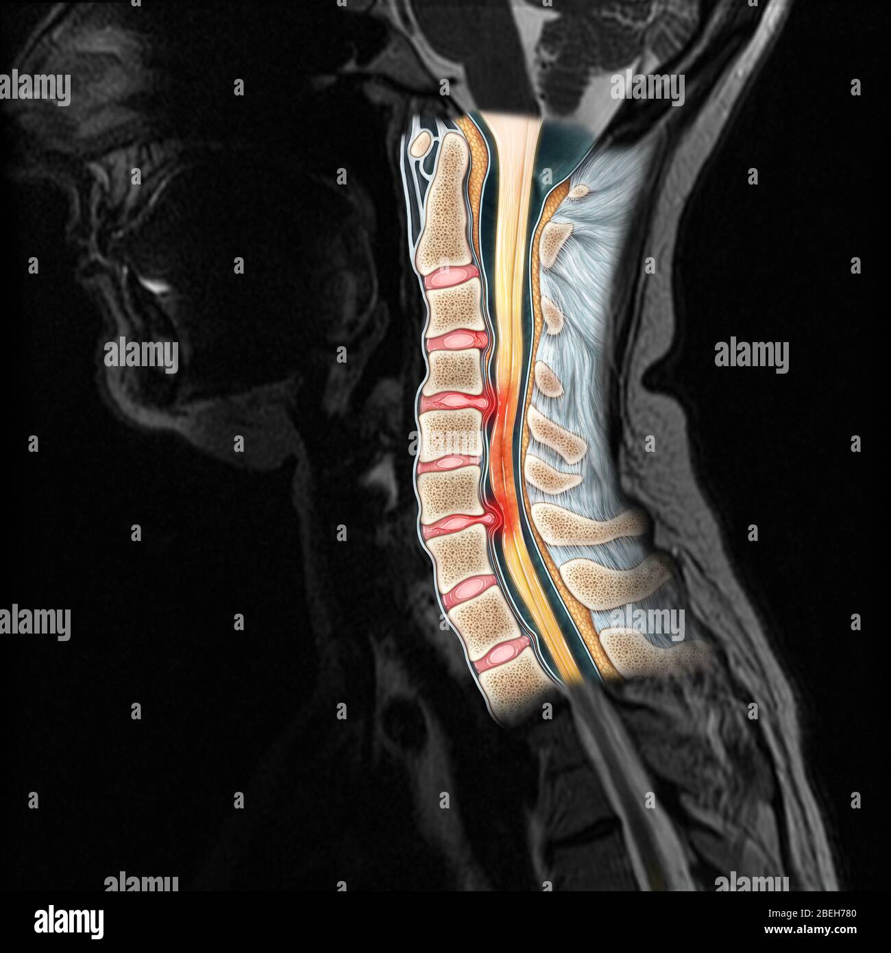 Cervical Spine Injury, MRI Stock Photo