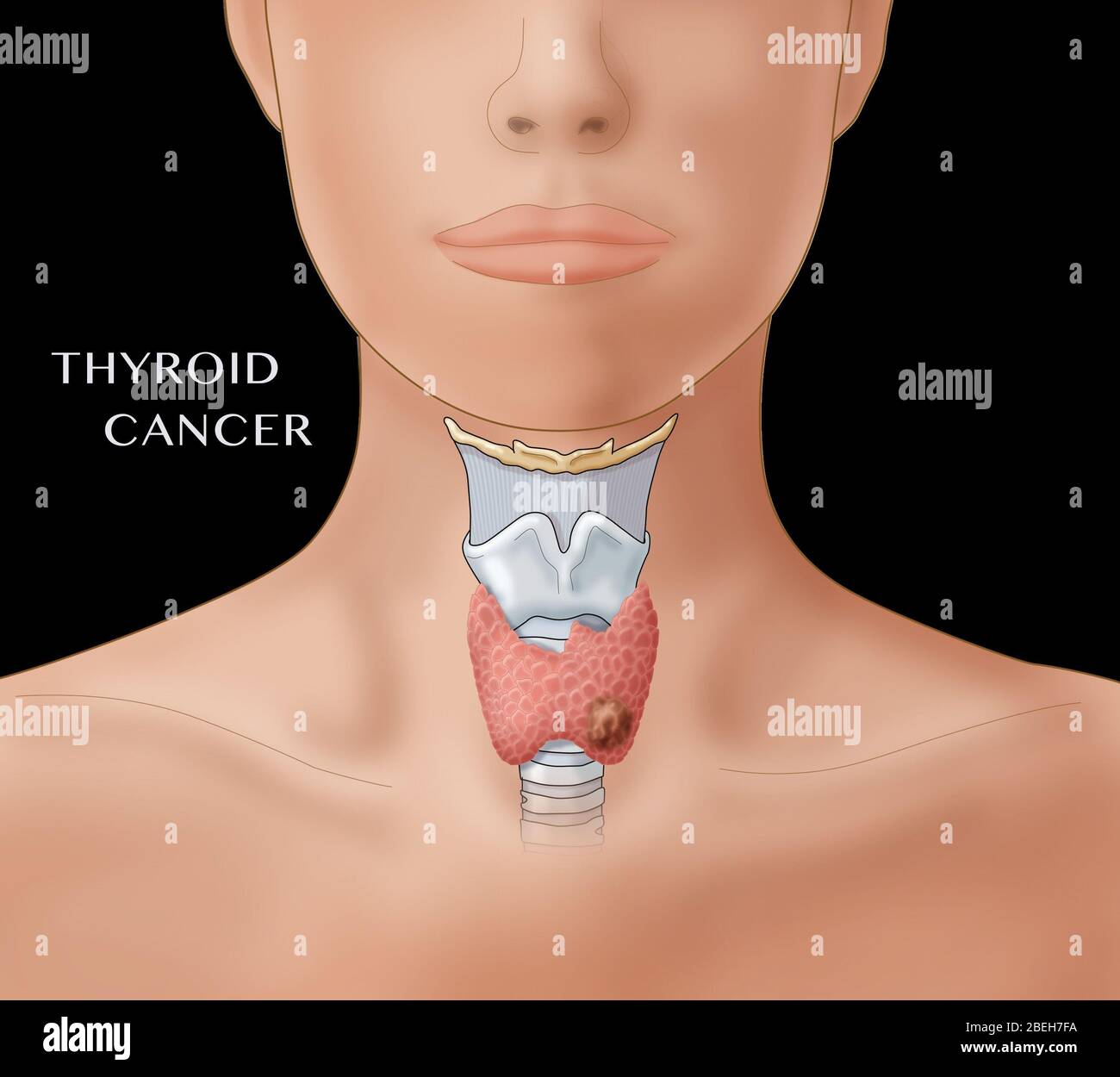 Thyroid Cancer Stock Photo
