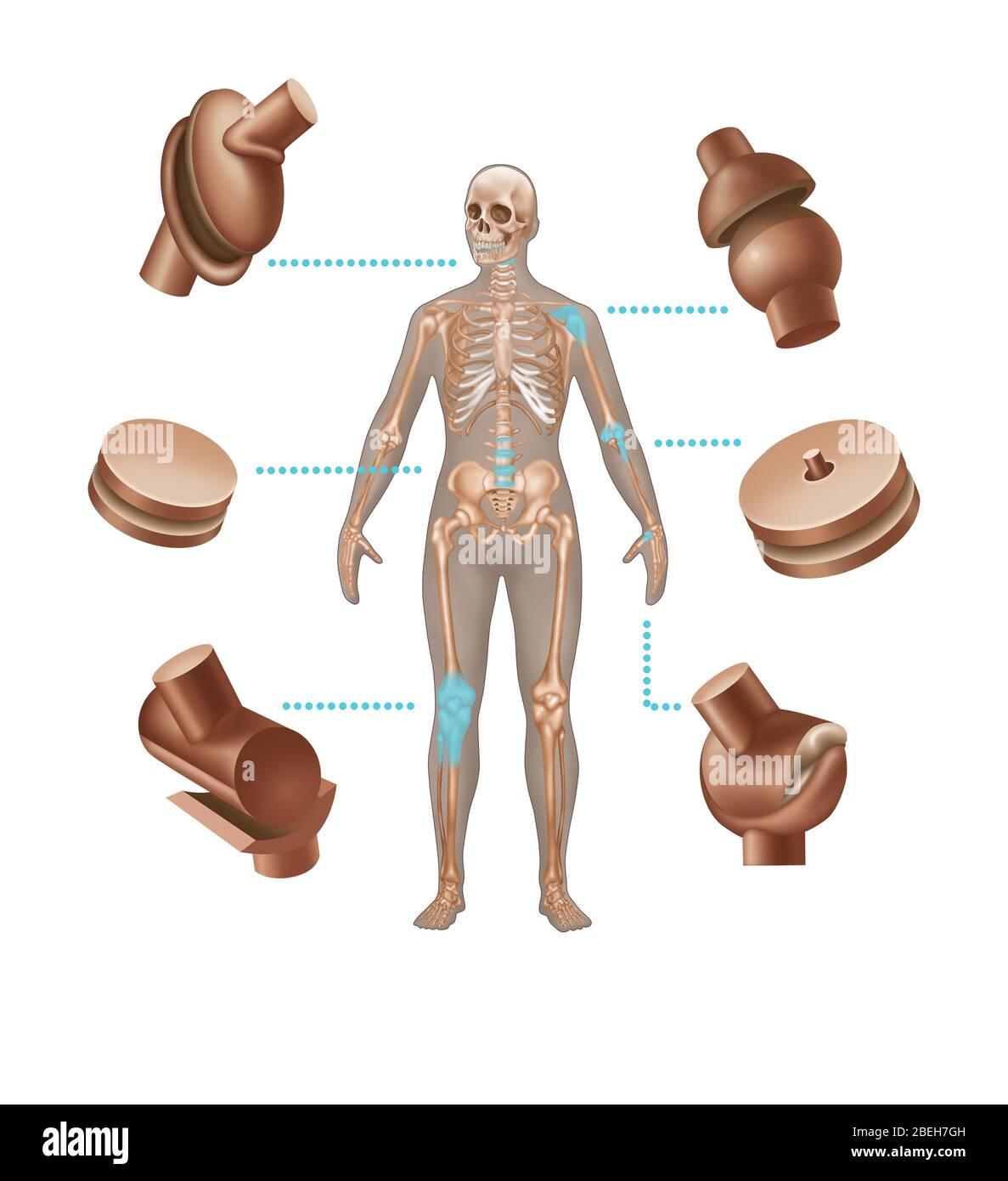 Human Joint Replacements, Illustration Stock Photo