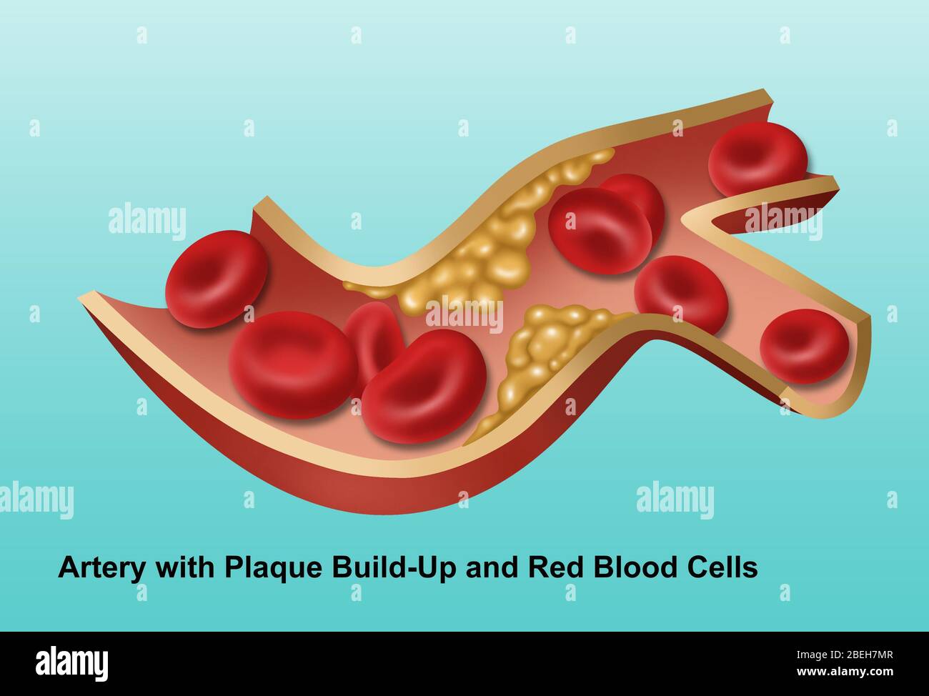Artery plaque hires stock photography and images Alamy