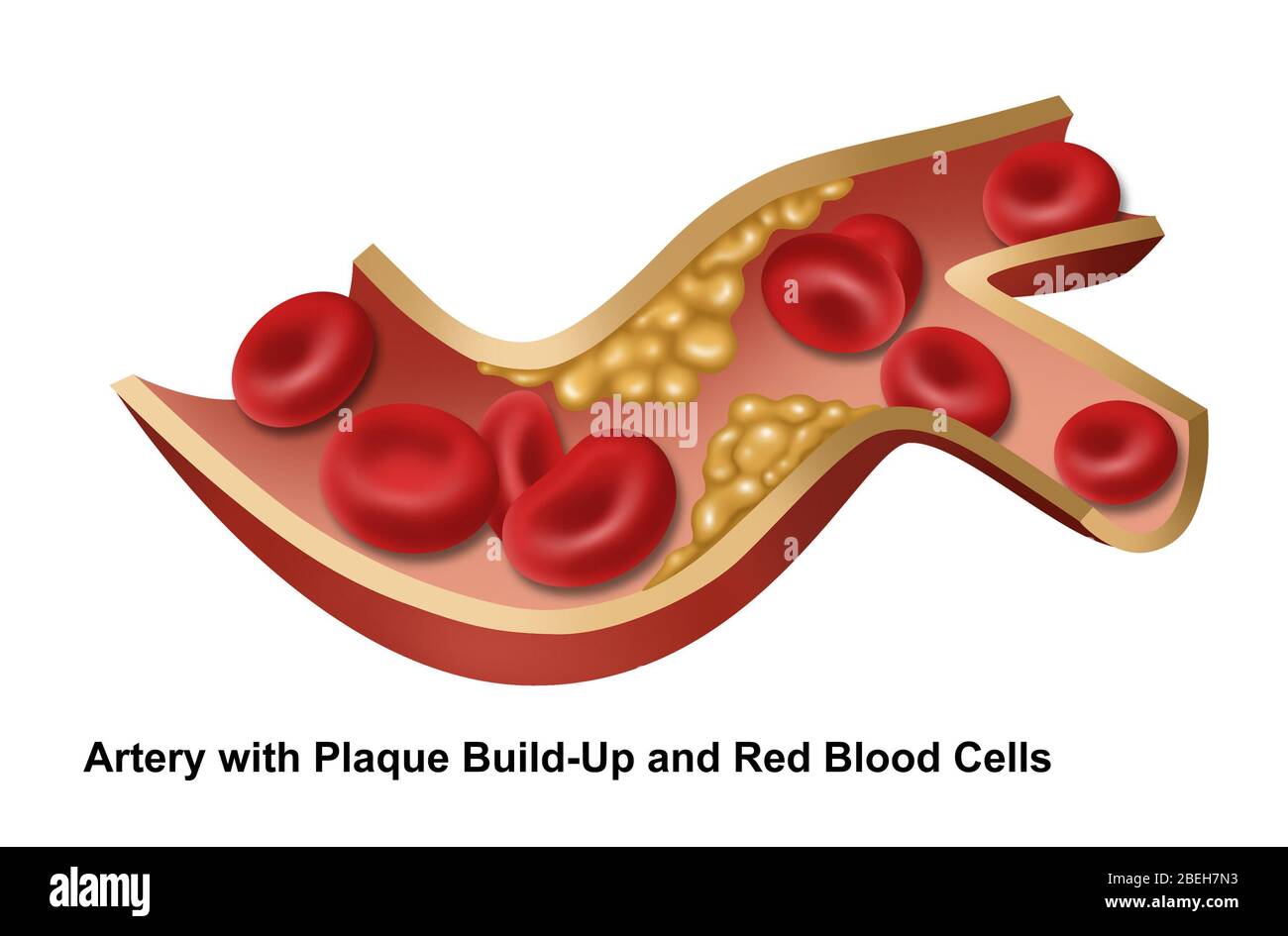 Plaque artery hires stock photography and images Alamy