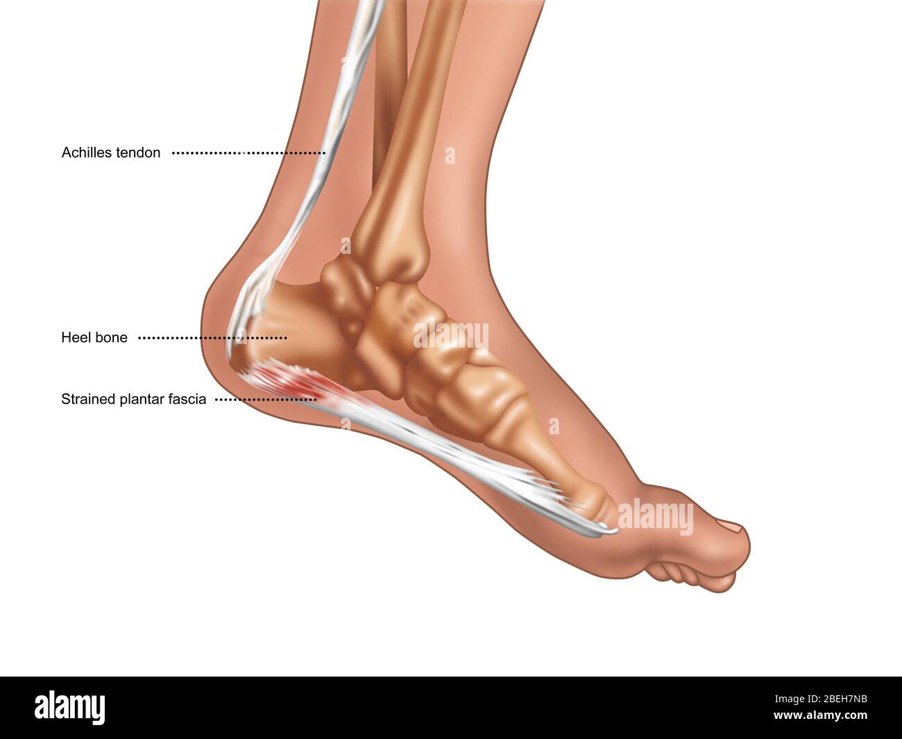 Strained Plantar Fascia, Illustration Stock Photo