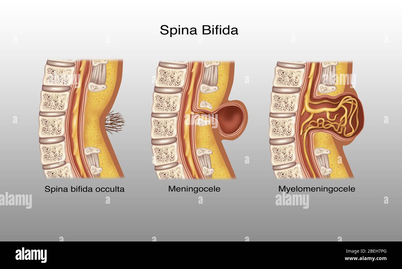 Spina Bifida, Illustration Stock Photo