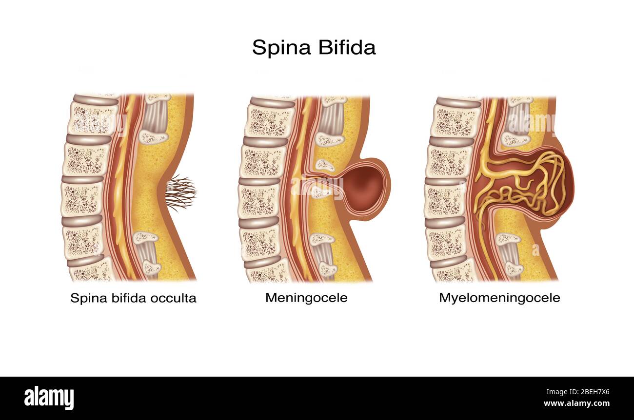 Spina Bifida, Illustration Stock Photo
