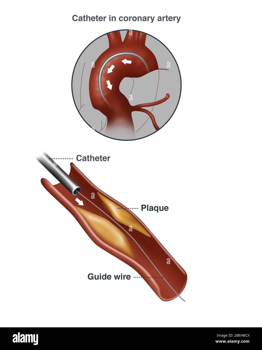 Fat build up in artery Cut Out Stock Images & Pictures Alamy