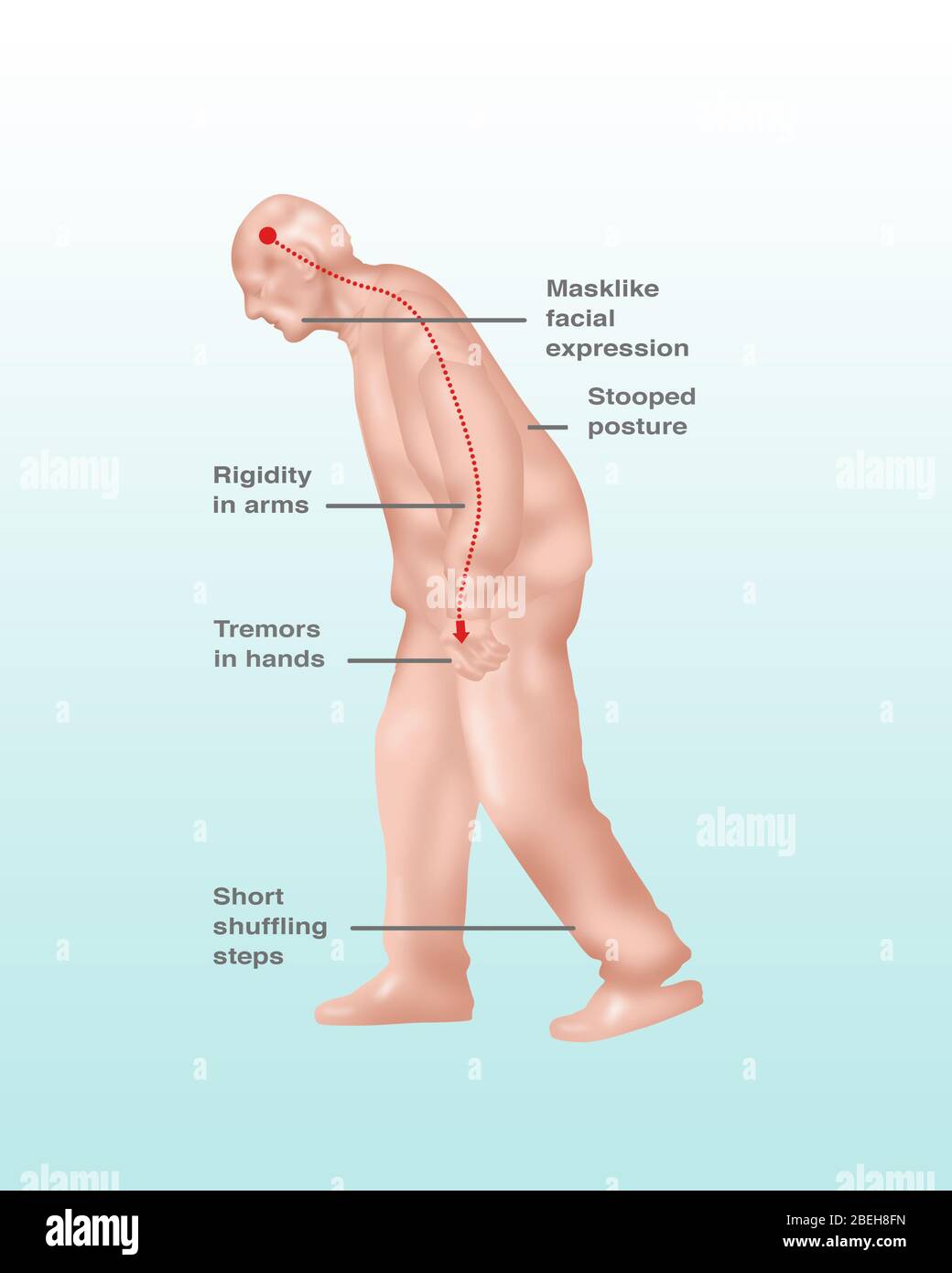 Parkinson's Symptoms, Illustration Stock Photo