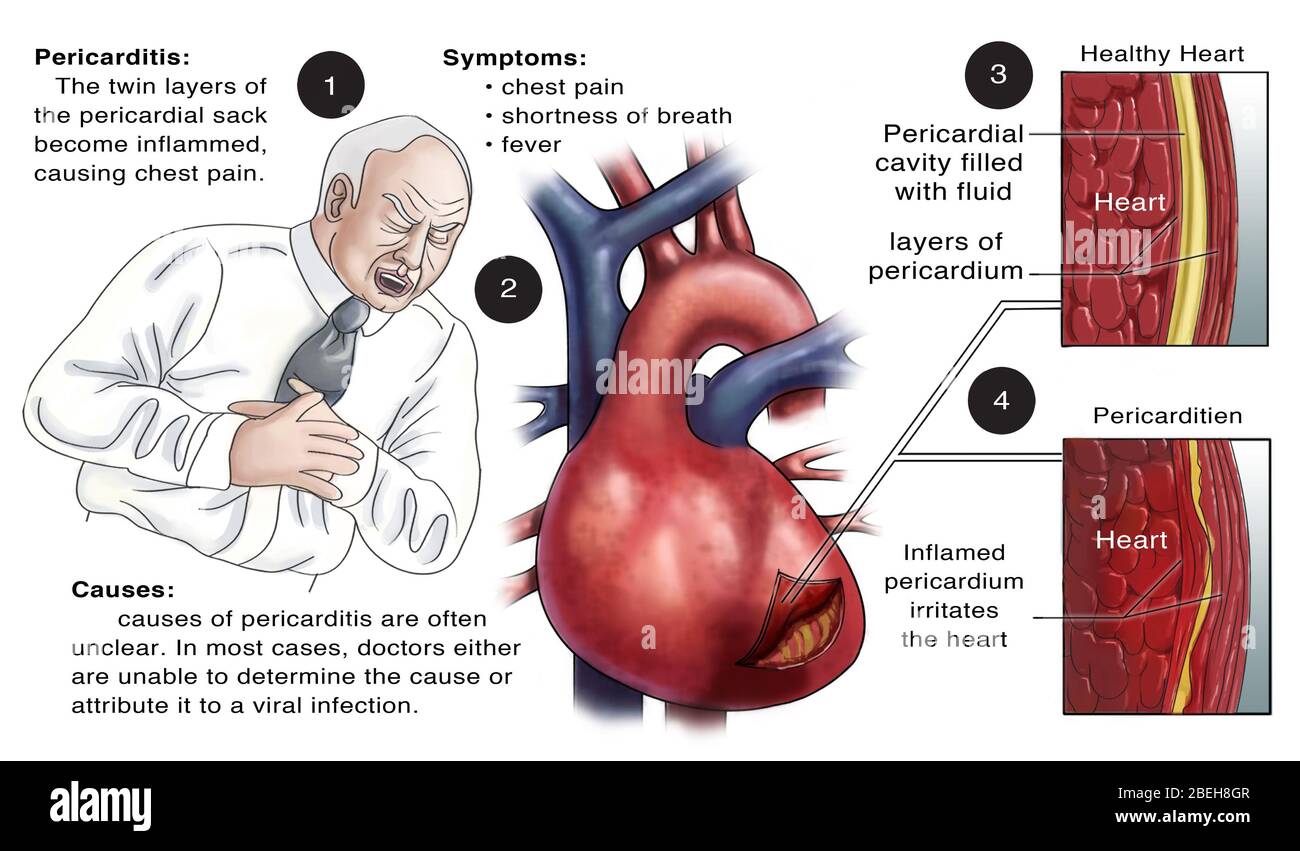 Pericarditis hi-res stock photography and images - Alamy