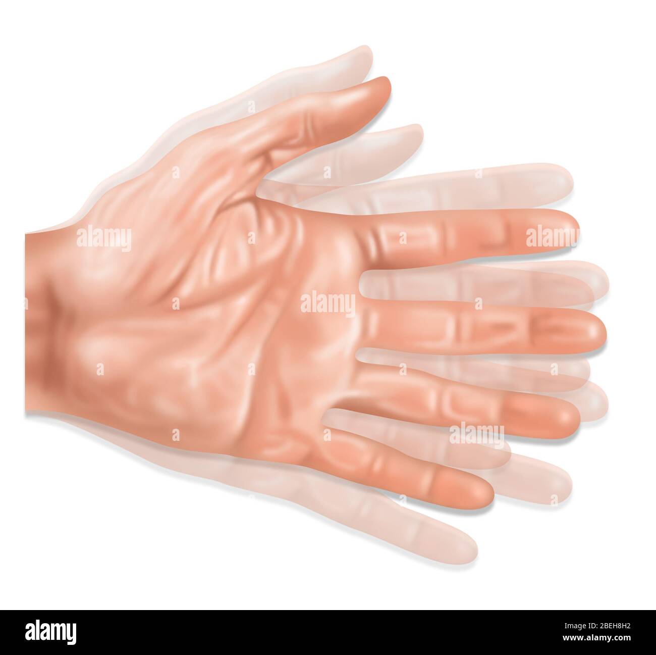 тремор дрожание рук. эссенциальный тремор го. тремор рук причины. дрожат руки причины.