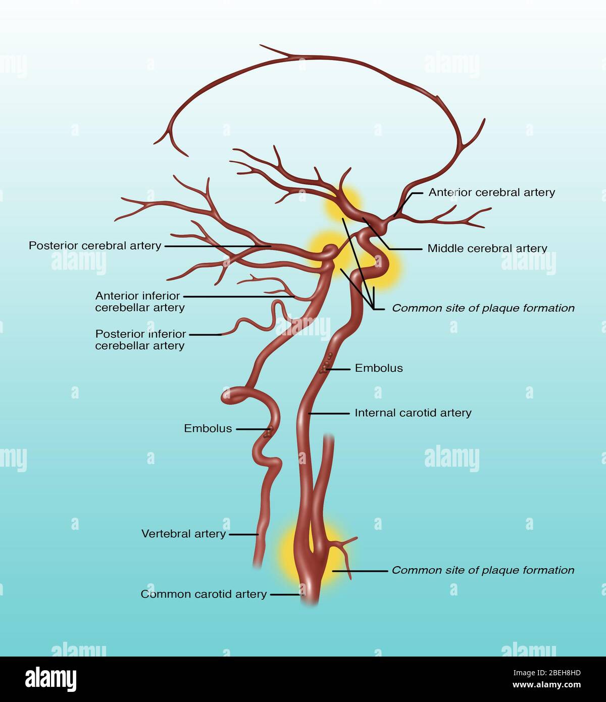 Common Blocked Arteries, Illustration Stock Photo