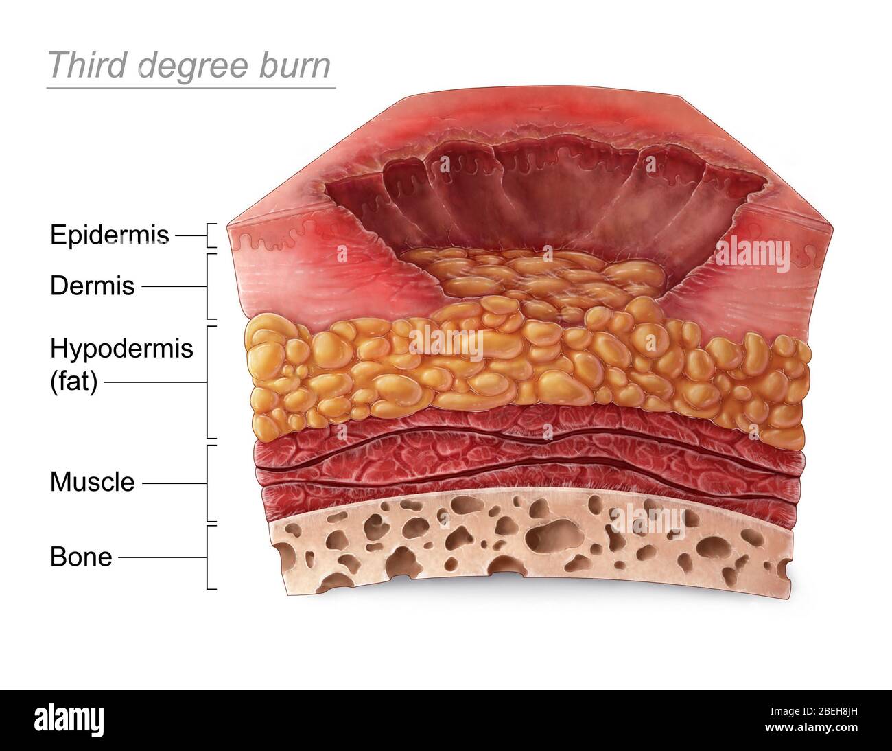 Third Degree Burn Stock Photo