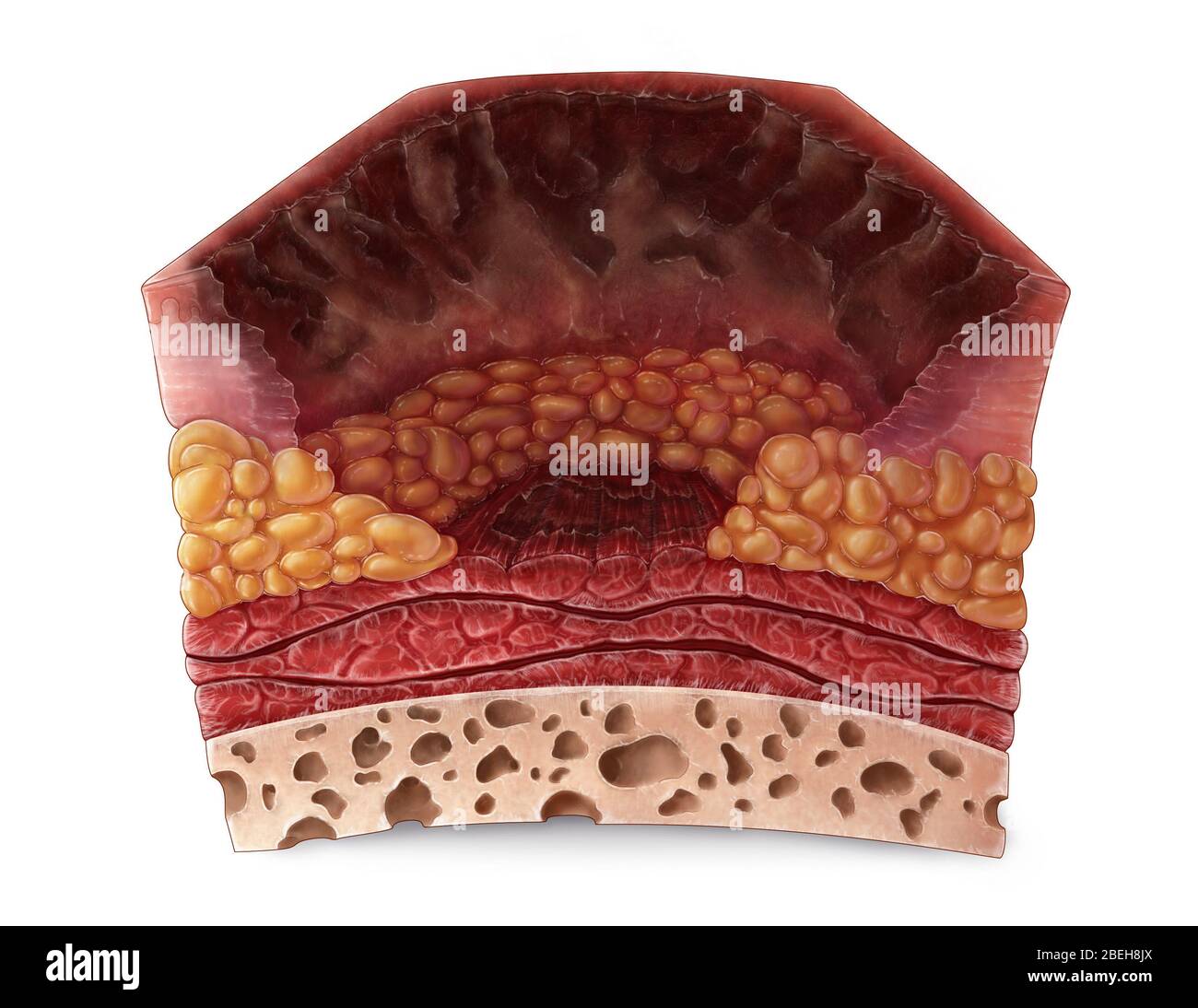 Fourth Degree Burn Stock Photo - Alamy