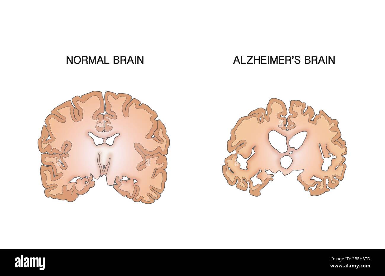 Alzheimer's and Normal Brains, Comparison Stock Photo