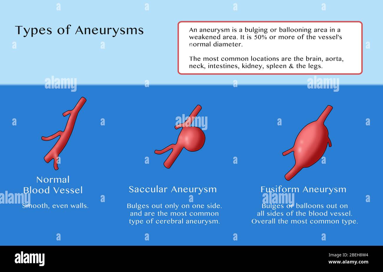 Infographic comparing a normal blood vessel (left) with two types of aneurysms: a saccular aneurysm (middle), which is the most common type of cerebral aneurysm, where the blood vessel bulges out on only one side; and a fusiform aneurysm (right), which is the most common general type, where the blood vessel bulges out on all sides. Stock Photo
