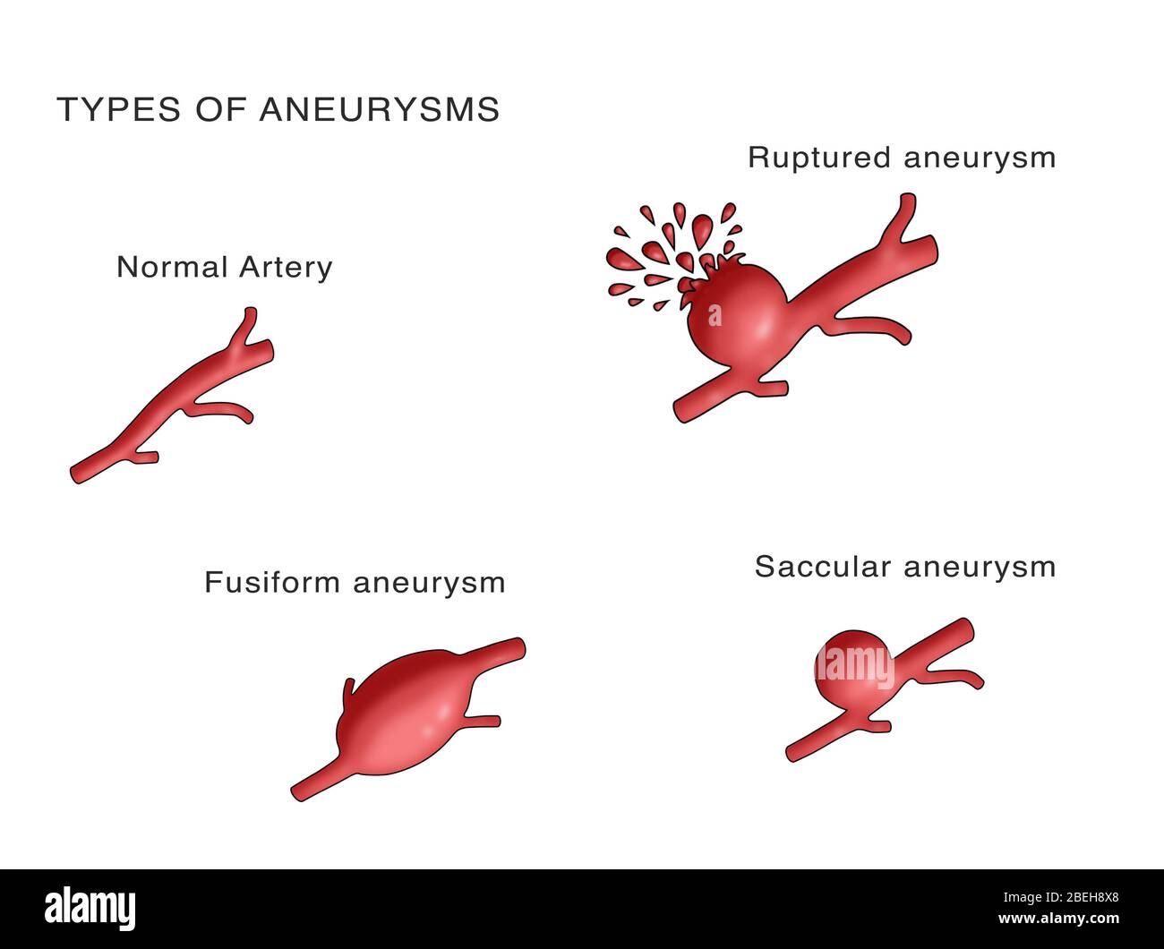 Cerebral aneurysm types